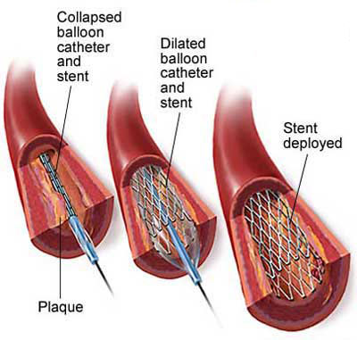 心脏血管支架